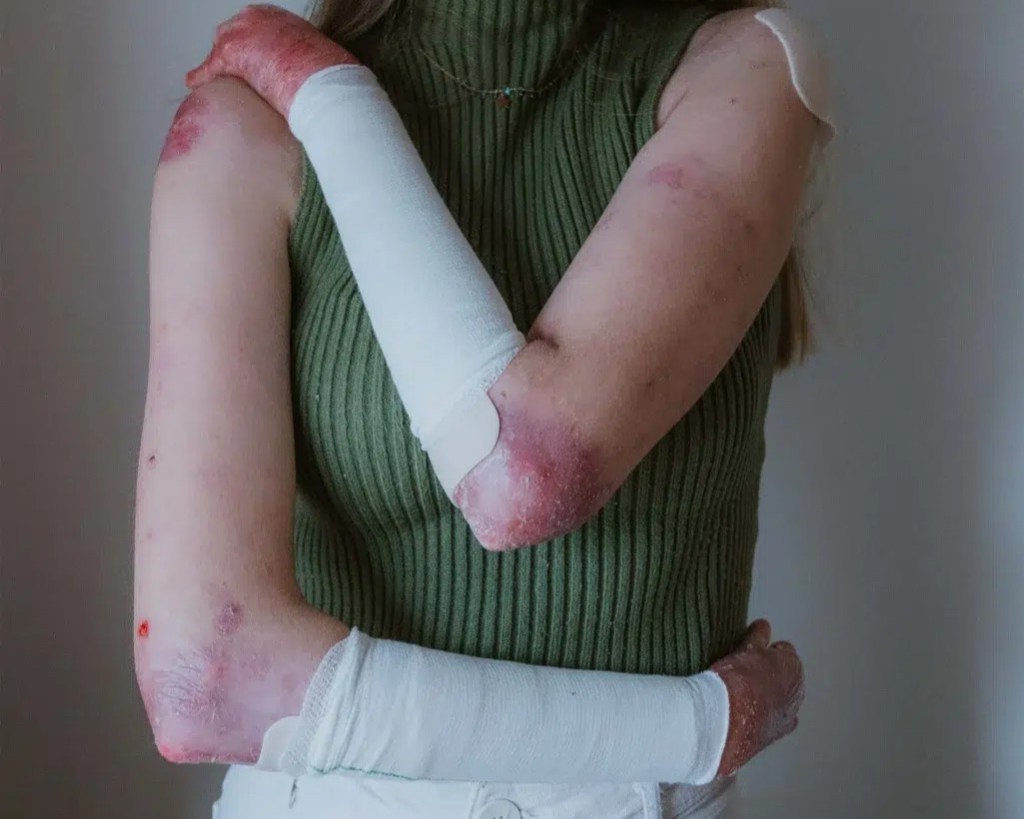 ¿Qué se esconde tras la «Piel de Mariposa» o «Piel de Cristal»? La Epidermólisis Ampollar al descubierto